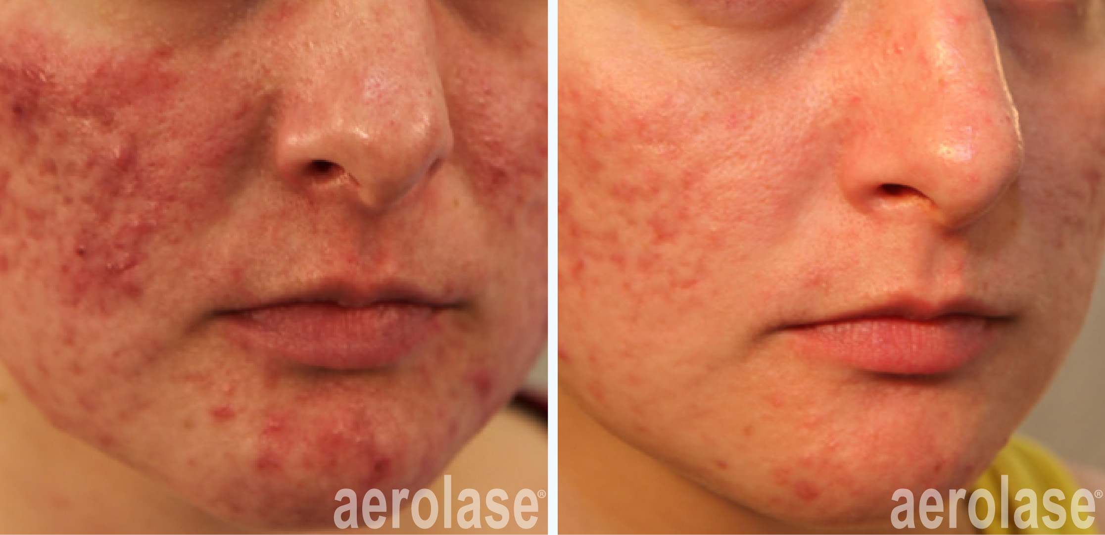 Treating acne using advanced 650-microsecond technology near FXBG