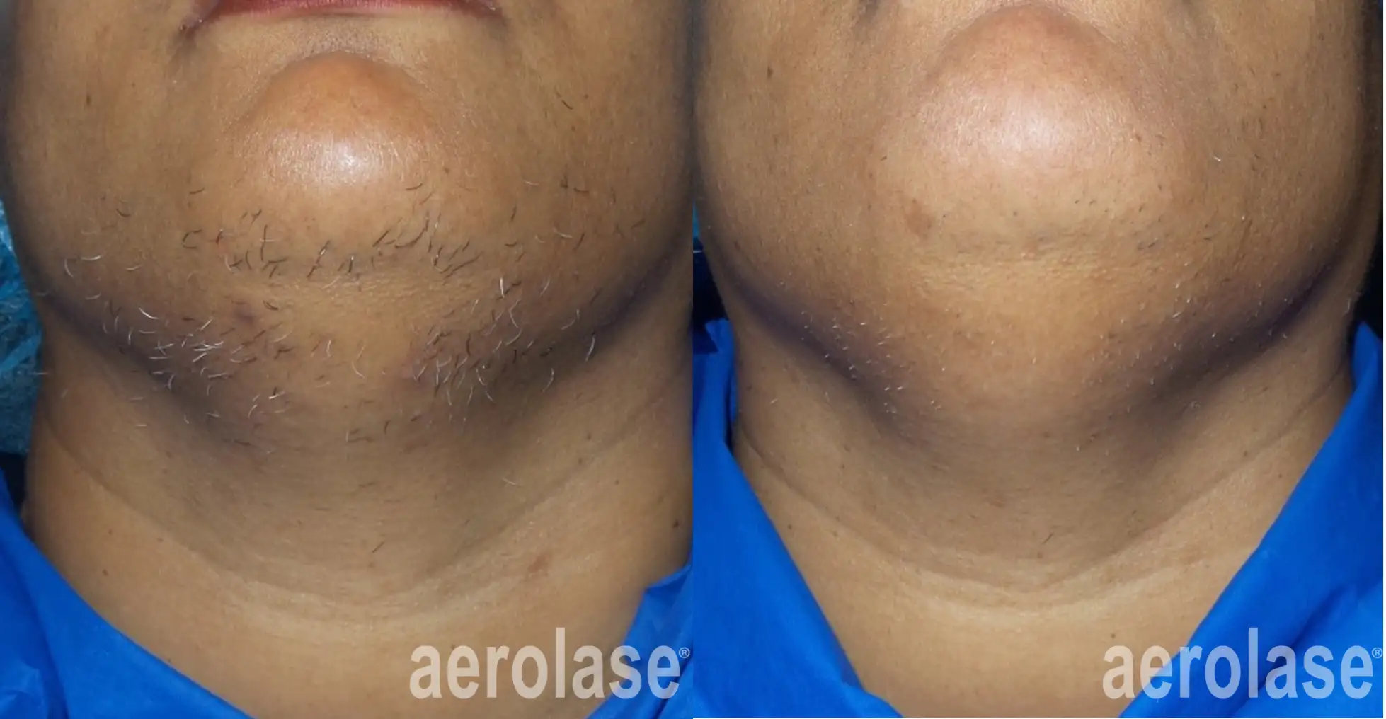 Painless laser hair removal with Aerolase Neo near FXBG