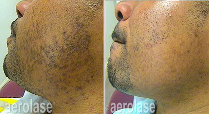 Pseudofolliculitis Barbae treatment with Aerolase Neo in Fredericksburg, VA