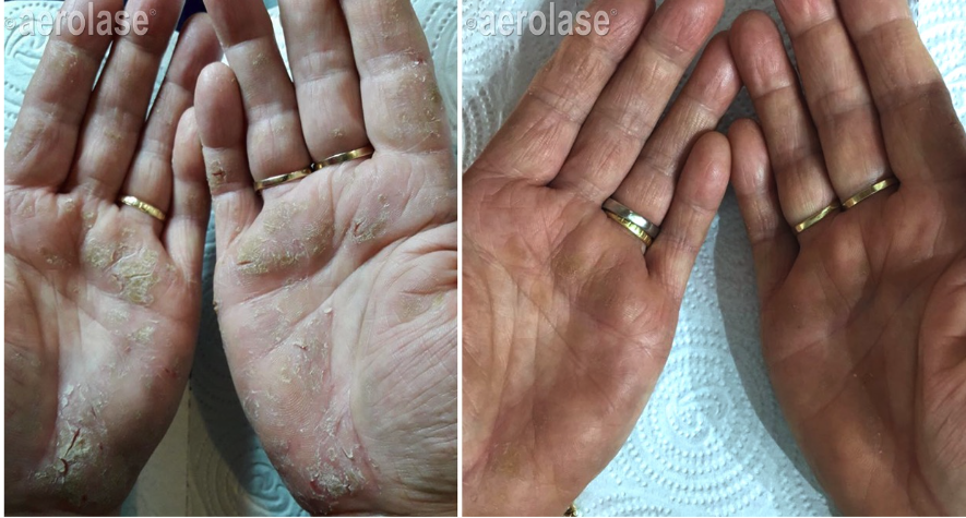Psoriasis Clearance Tretament with Aerolase Neo in Virginia Fredericksburg