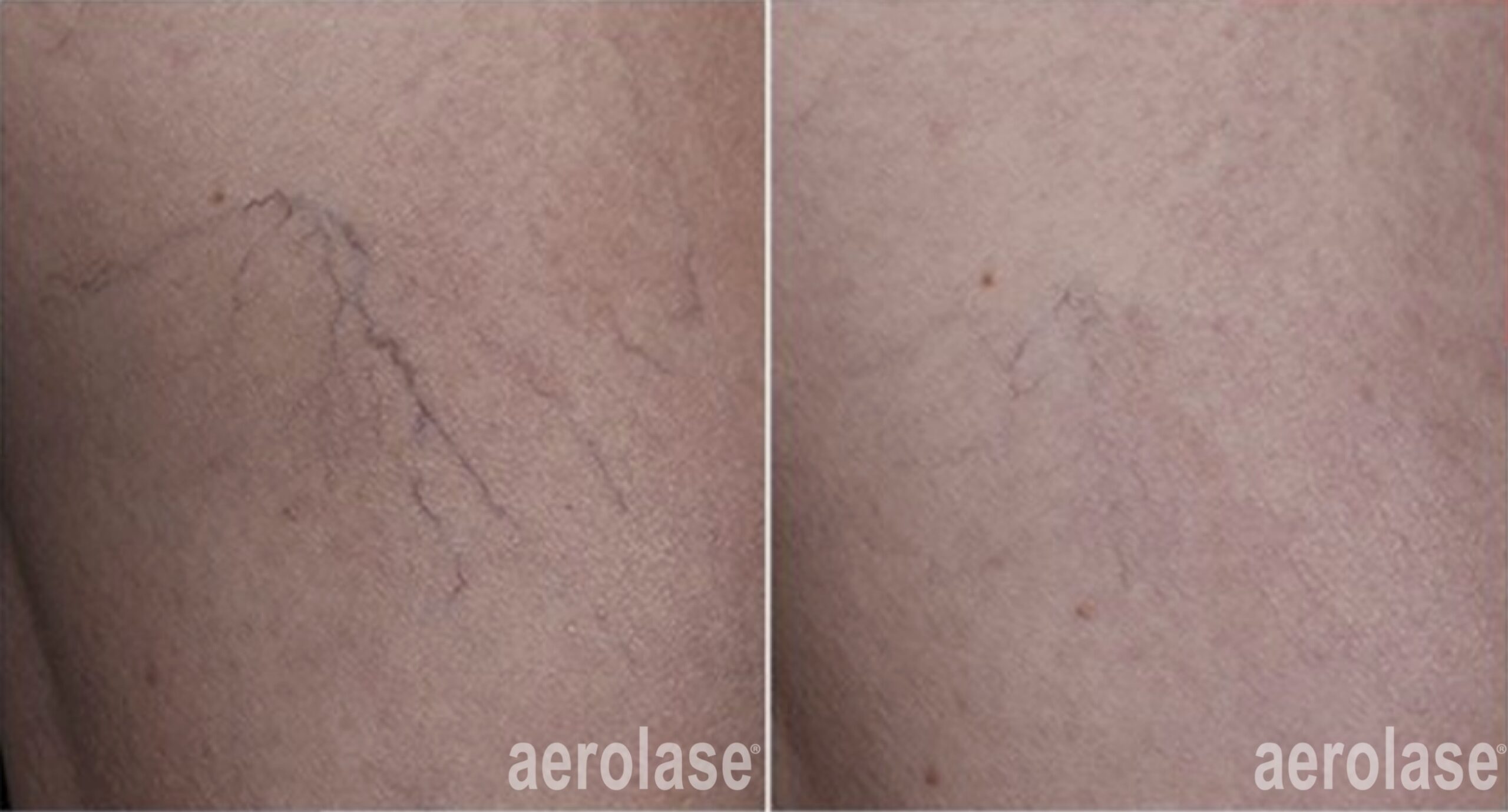 Aerolase Neo for Rosacea, Redness and Veins in Fredericksburg, VA