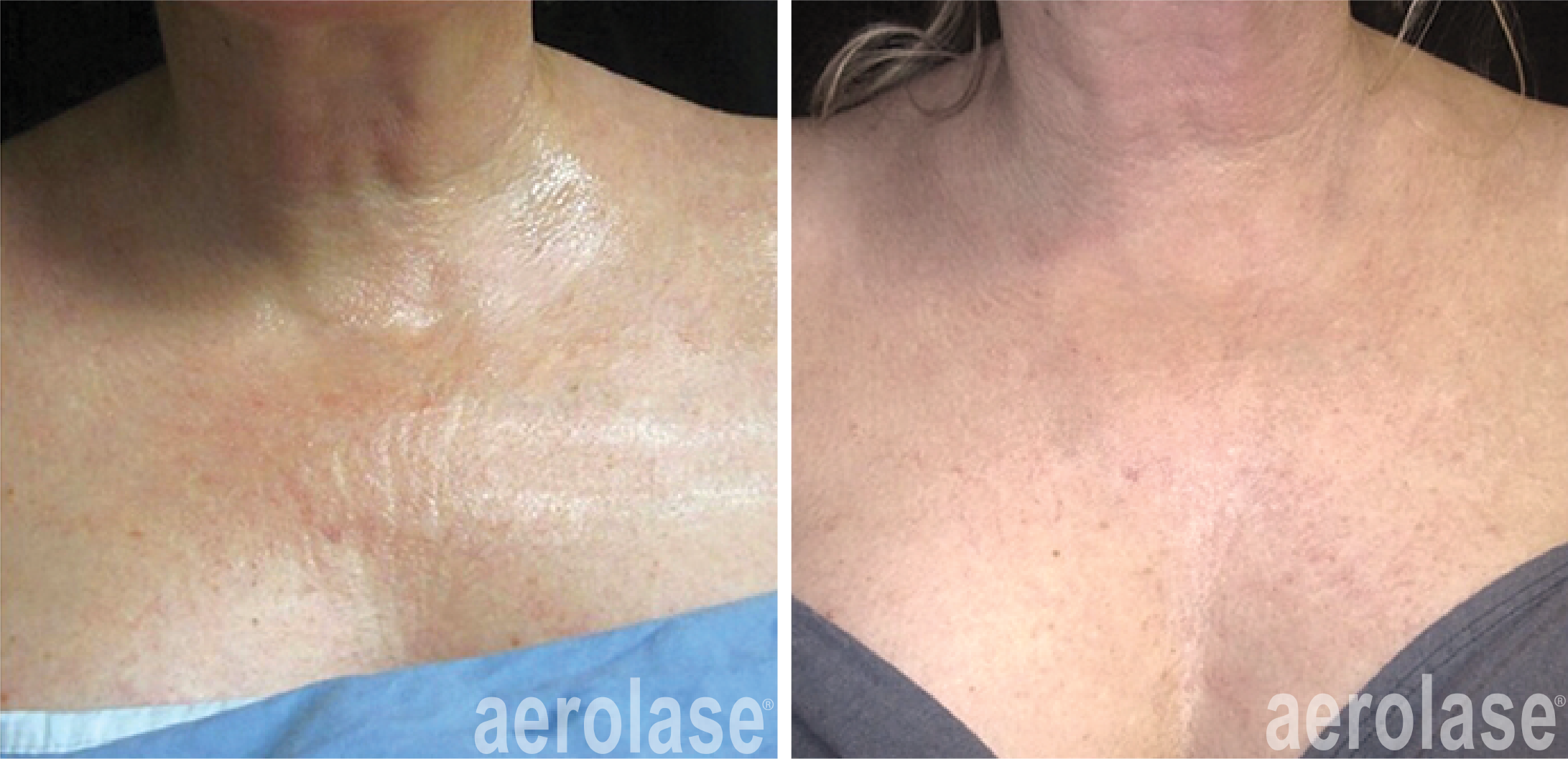 Aerolase Neo for Rejuvenation and Tightening near Fredericksburg