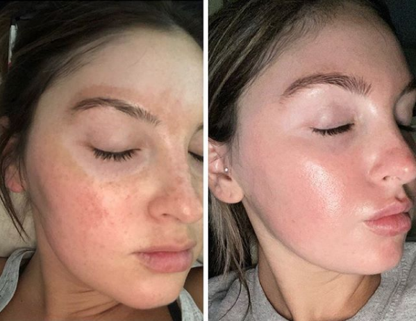 Custom Blend Facial Treatment in Fredericksburg